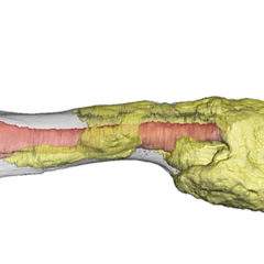 Bone Cancer Diagnosed in Dinosaur